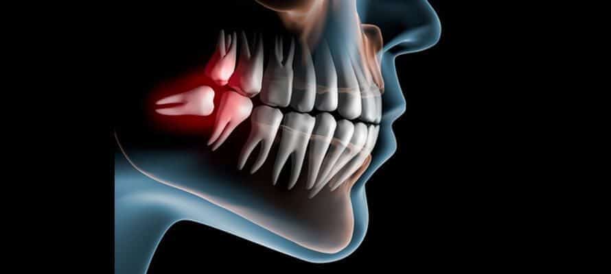 Wisdom Teeth Pain Relief