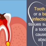 Antibiotics for Tooth Infection