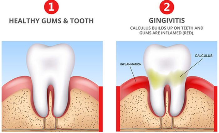 How to treat Gingivitis 2